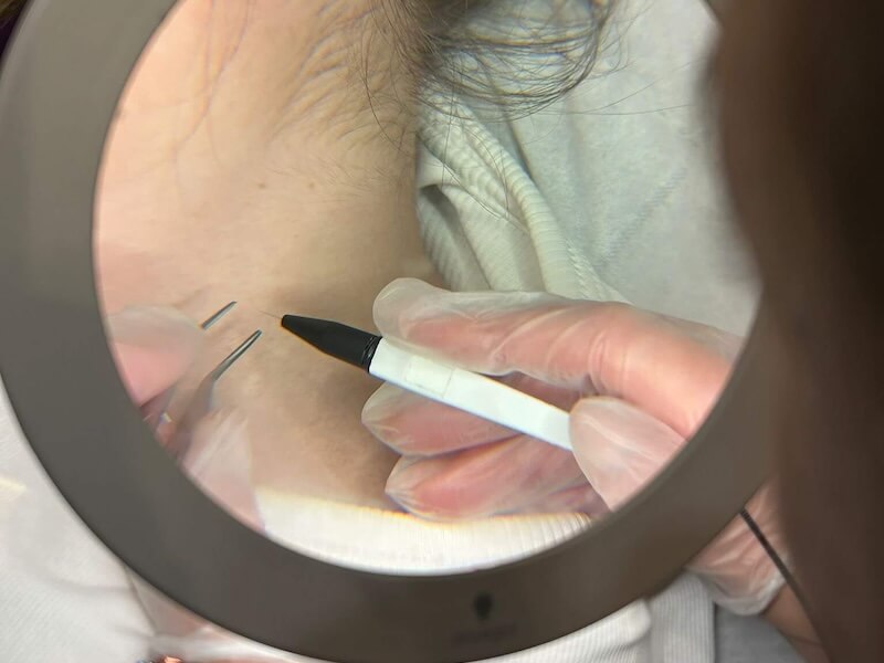 Advanced Blemish Removal 1 Inverness Ear Piercing System Thame